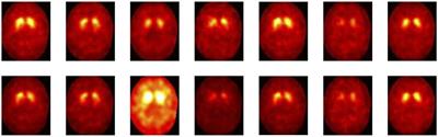 Robust Ensemble Classification Methodology for I123-Ioflupane SPECT Images and Multiple Heterogeneous Biomarkers in the Diagnosis of Parkinson's Disease